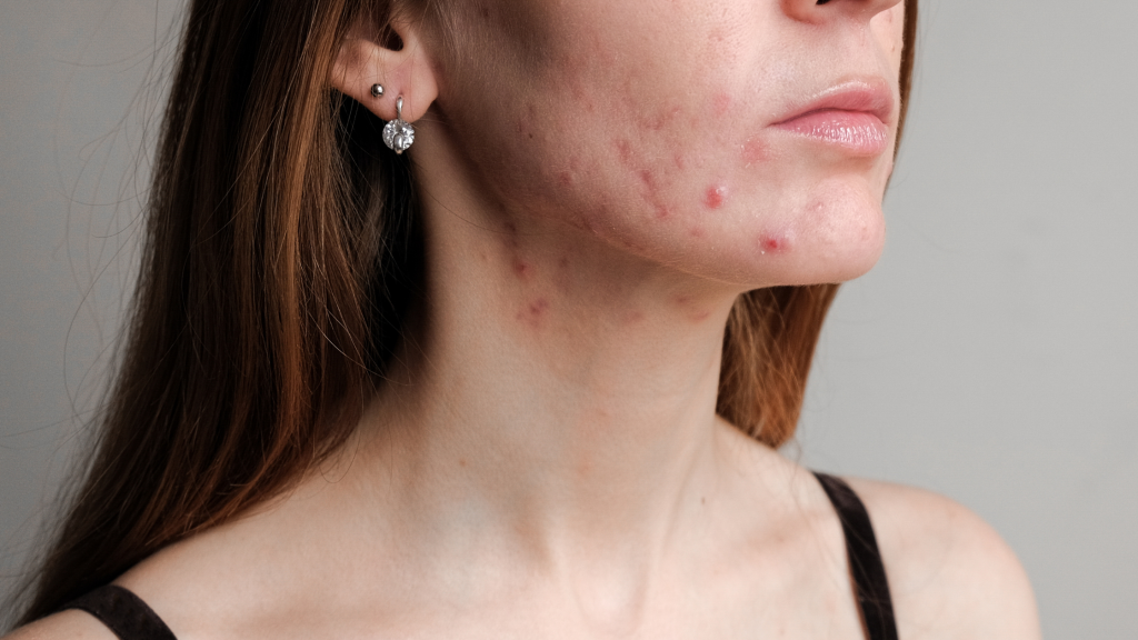 Pcos And Acne The Connection Causes And Natural Treatment Options